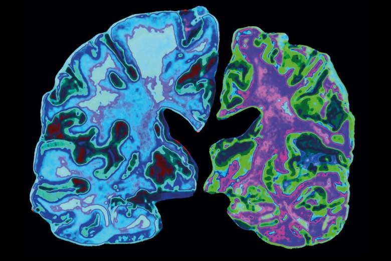 Болезнь Альцгеймера, разрушившая правое полушарие головного мозга. Фото: Jessica Wilson / Science Photo Library