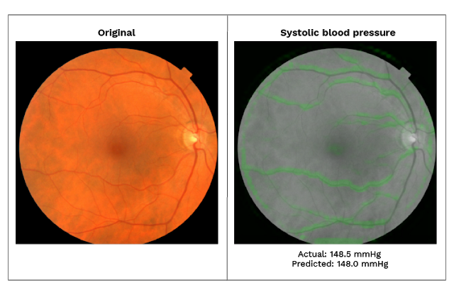 Слева: фото сетчатки глаза в цвете. Справа: черно-белый снимок с областями, прогнозирующими повышение артериального систолического давления. Фото: verily.com