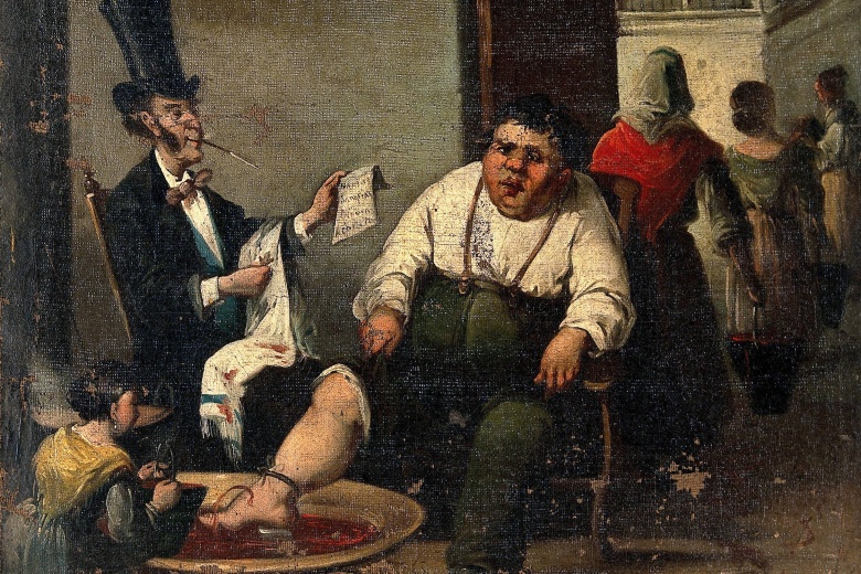 Кровопускание из ноги. Фрагмент картины по гравюре Оноре Домье (1808–1879)