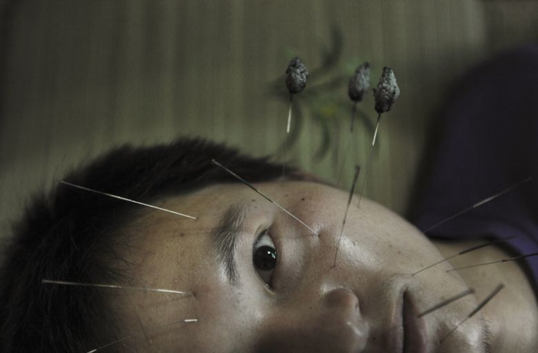 Лечение акупунктурой в Китае. Фото: Reuters