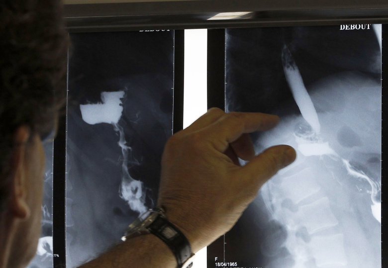 Рентгеновский снимок желудка с бандажом. Фото: Regis Duvignau / Reuters